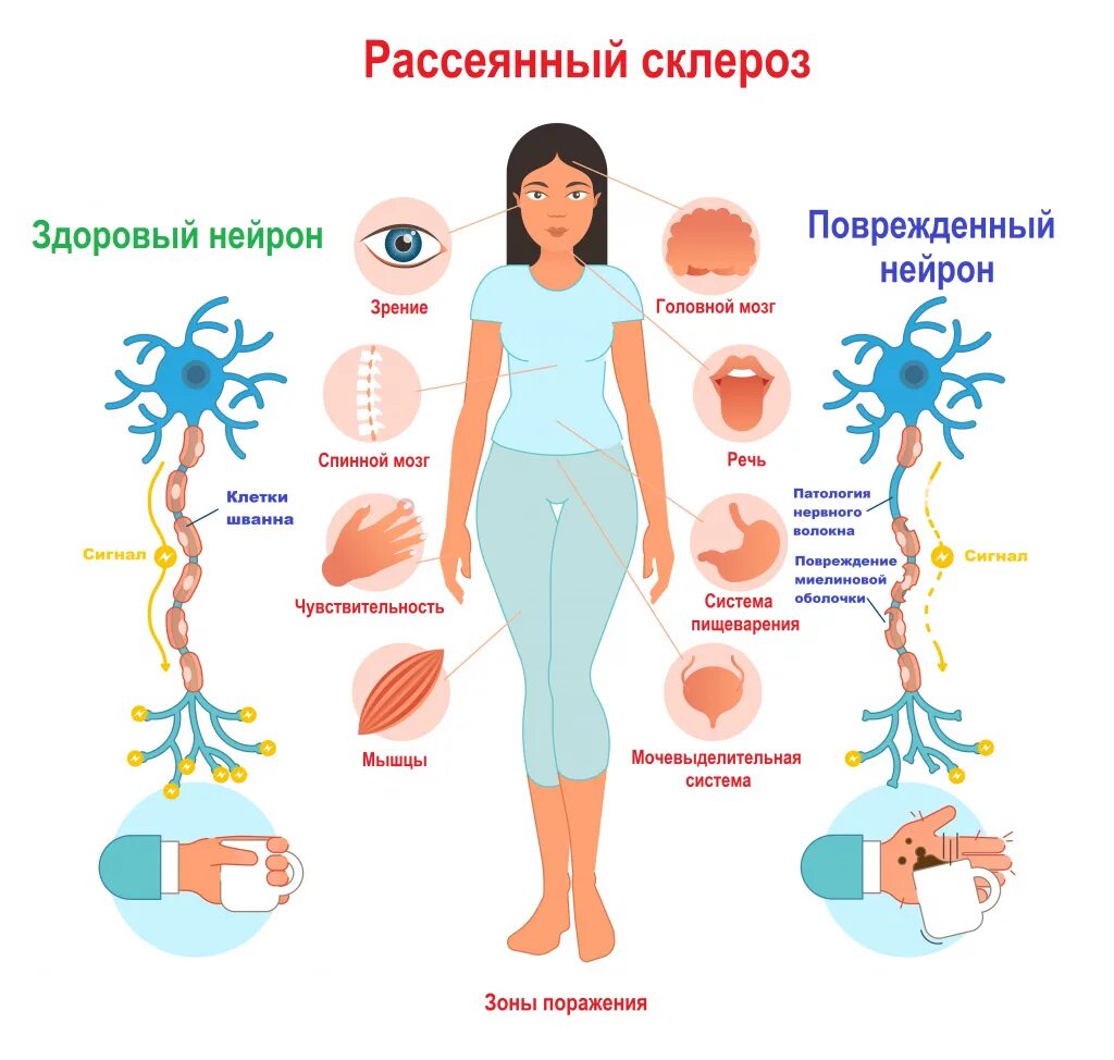 Рассеянный склероз фото больных на последней стадии Рассеянный склероз - причины появления, симптомы заболевания, диагностика и спос