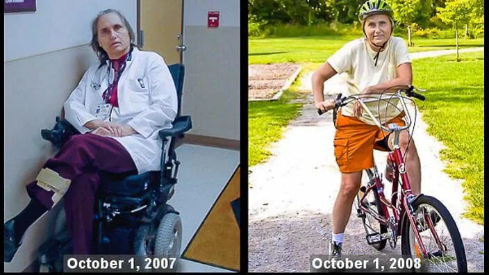 Рассеянный склероз фото больных на последней стадии US medical academic, Dr Terry Wahls, was diagnosed with MS at age 45. Determined