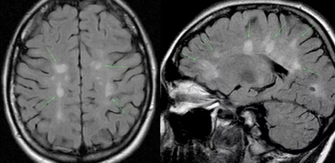 Рассеянный склероз симптомы фото Что показывает МРТ головы, показания и противопоказания