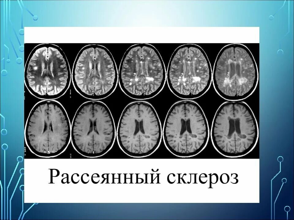 Рассеянный склероз симптомы фото Картинки ОТ ЧЕГО БЫВАЕТ СКЛЕРОЗ