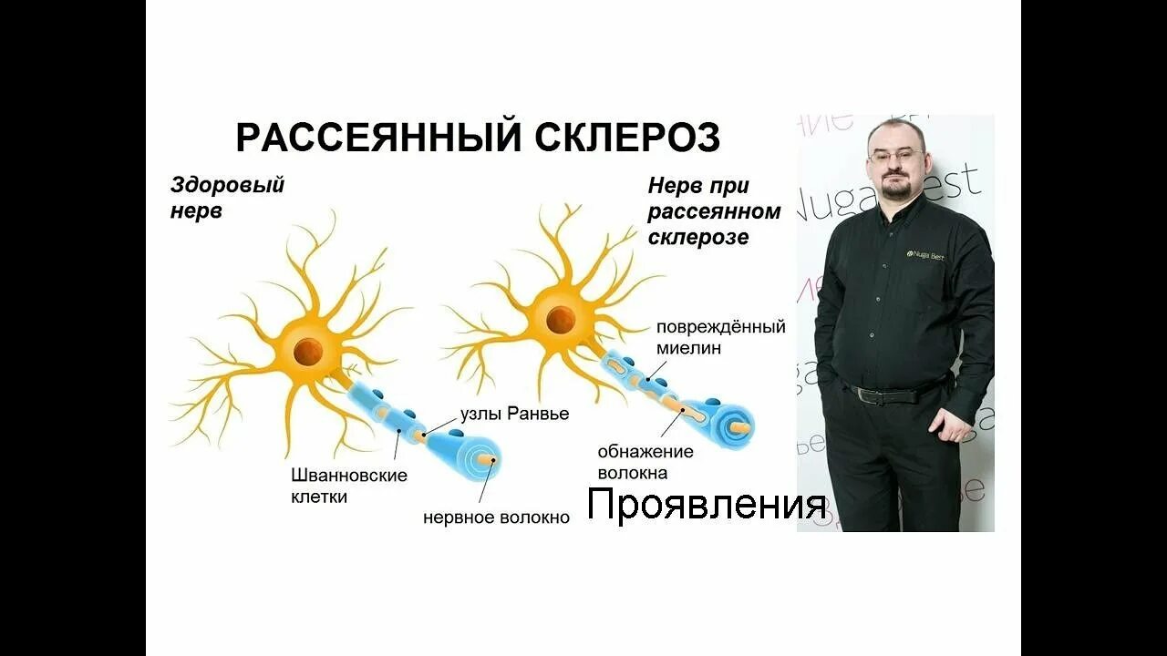 Рассеянный склероз симптомы фото Рассеянный склероз - проявления. - YouTube