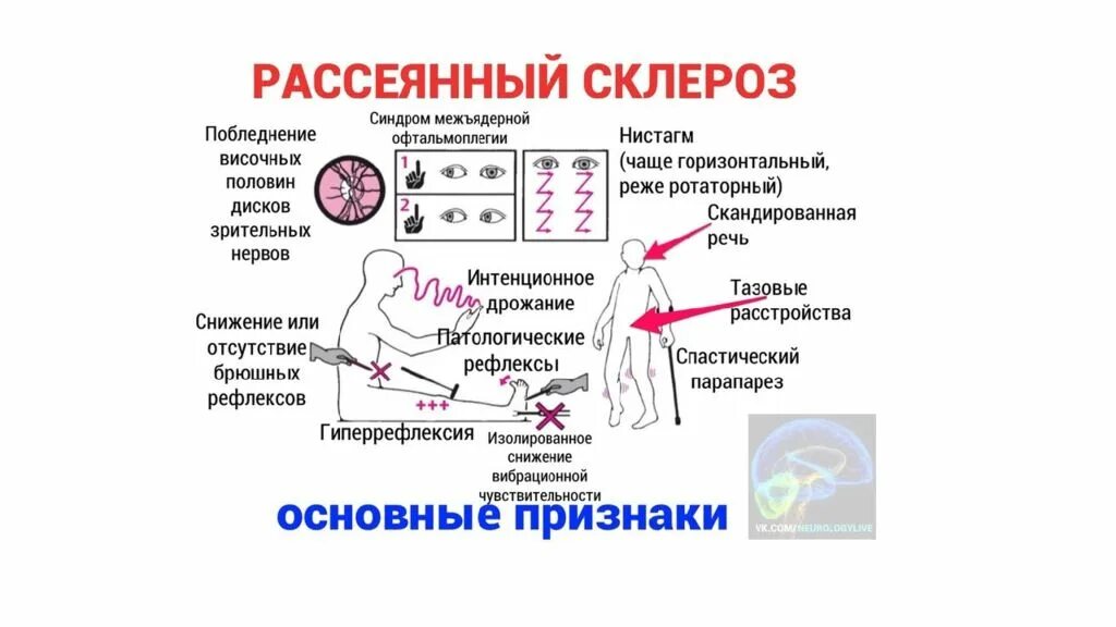 Рассеянный склероз симптомы фото Картинки РАССЕЯННЫЙ СКЛЕРОЗ ОТ ЧЕГО ВОЗНИКАЕТ