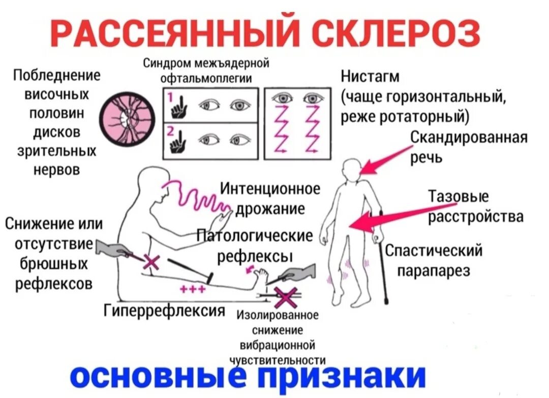 Рассеянный склероз симптомы фото Признаки заболевания склероза