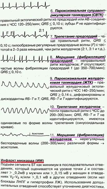 Расшифровать кардиограмму сердца онлайн по фото Экг диаграмма расшифровка