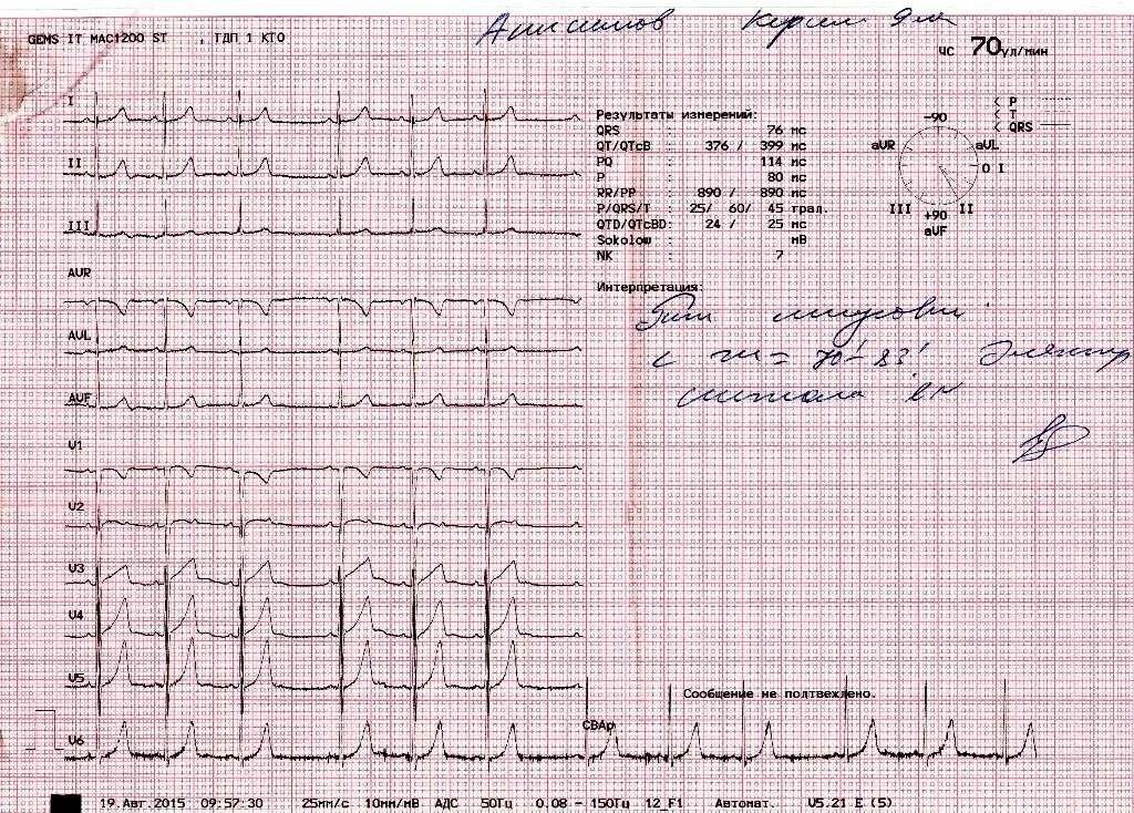 Расшифровать кардиограмму сердца онлайн по фото Экг с расшифровкой рядом: найдено 68 изображений