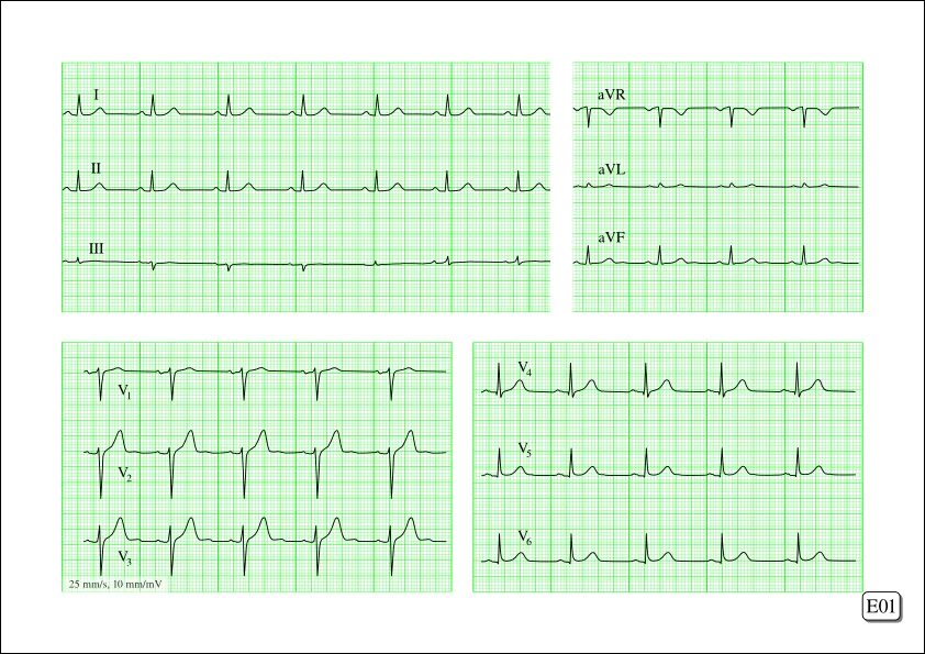 Расшифровка кардиограммы сердца онлайн по фото Creation of an ECG workbook with Scribus