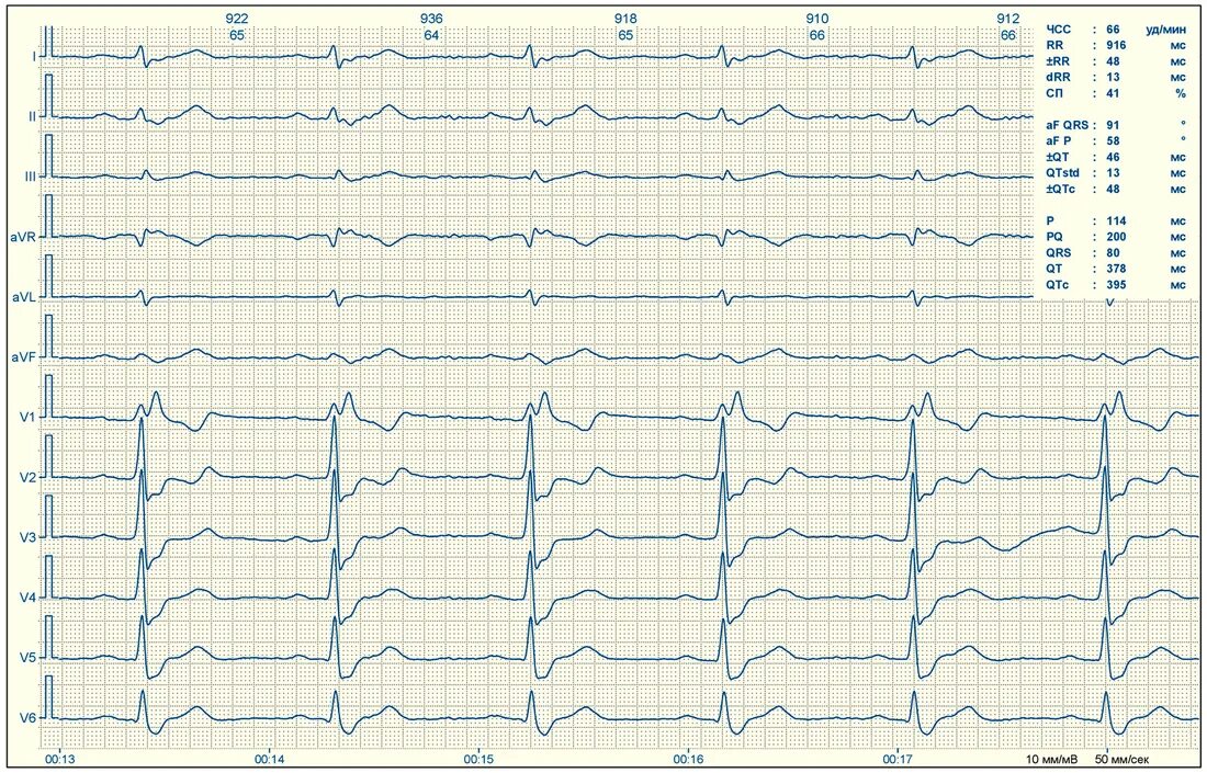 Расшифровка кардиограммы сердца онлайн по фото Пришла на медосмотр для ГАИ, а врач: "У вас сердце 70-летнего человека"