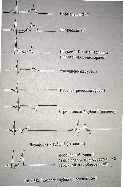 Расшифровка кардиограммы сердца онлайн по фото Практика фельдшера - Портал о скорой помощи и медицине