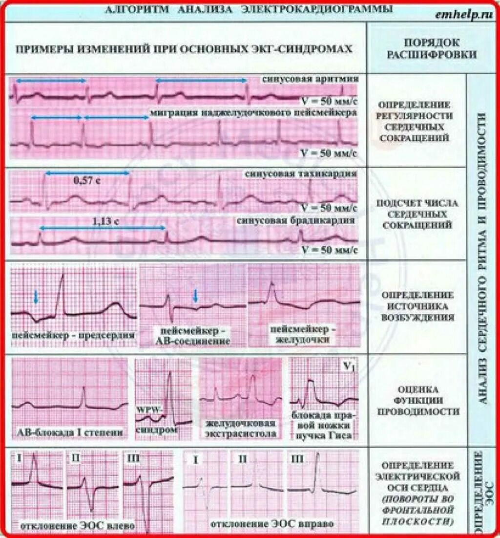 Расшифровка кардиограммы сердца у взрослых по фото Расшифровка экг: наиболее важные показатели кардиограммы с примерами нарушений