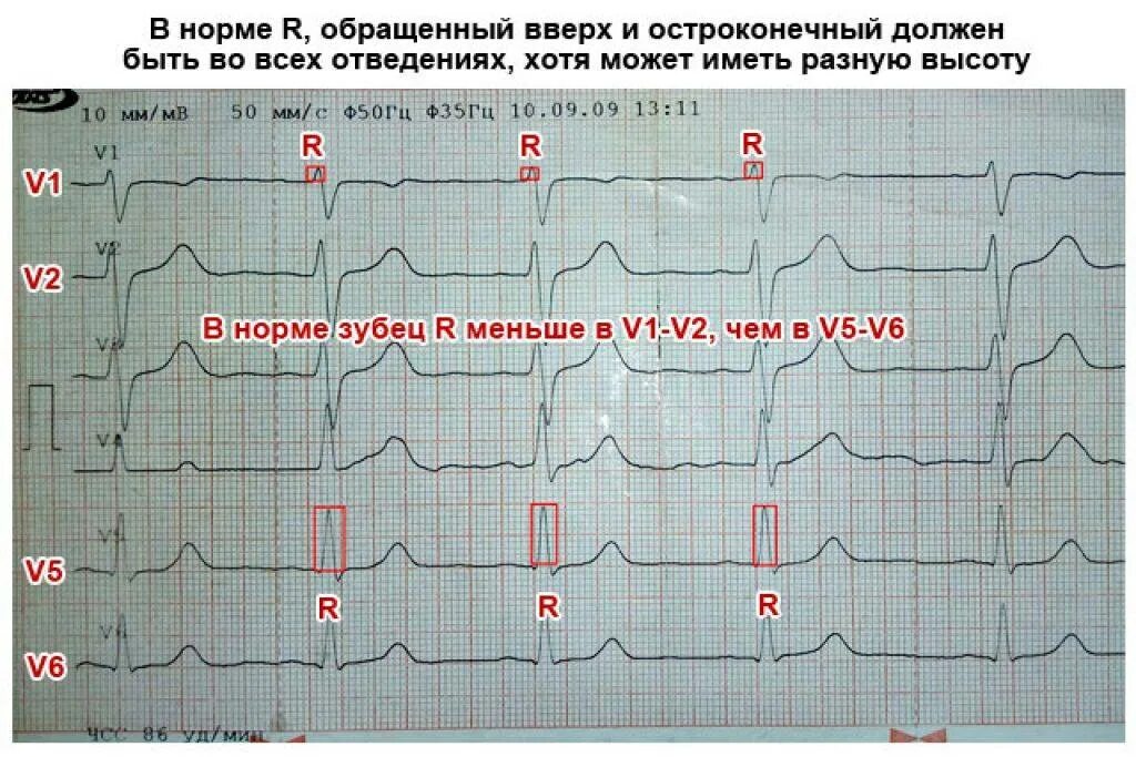 Расшифровка кардиограммы сердца у взрослых по фото Картинки КАРДИОГРАММА СЕРДЦА РАСШИФРОВКА ФОТО