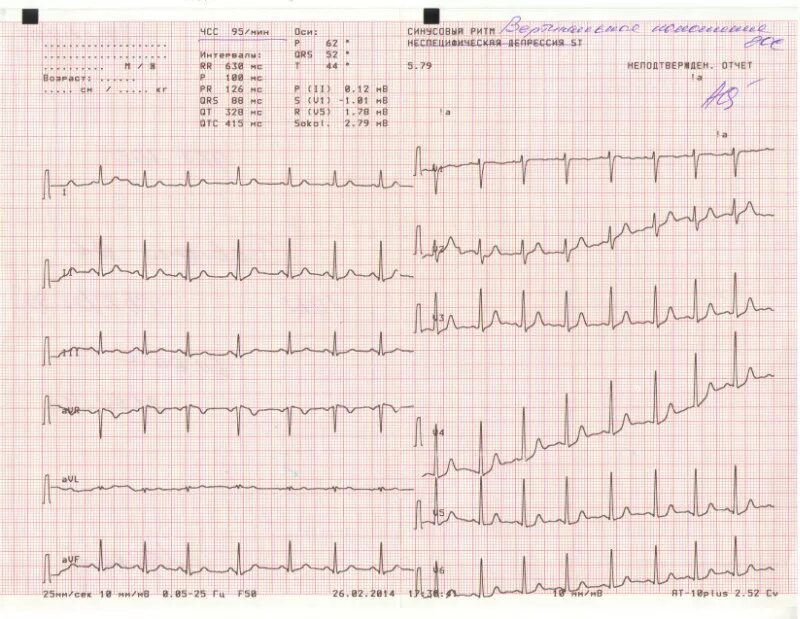 Расшифровка кардиограммы сердца у взрослых по фото Помогите расшифровать ЭКГ - Вопрос кардиологу - 03 Онлайн