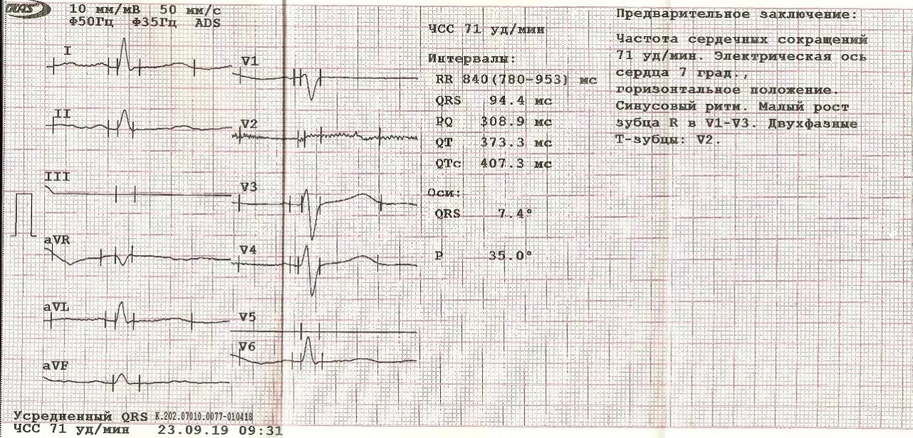 Расшифровка кардиограммы сердца у взрослых по фото Очень нужна расшифровка кардиограммы! - Вопрос кардиологу - 03 Онлайн