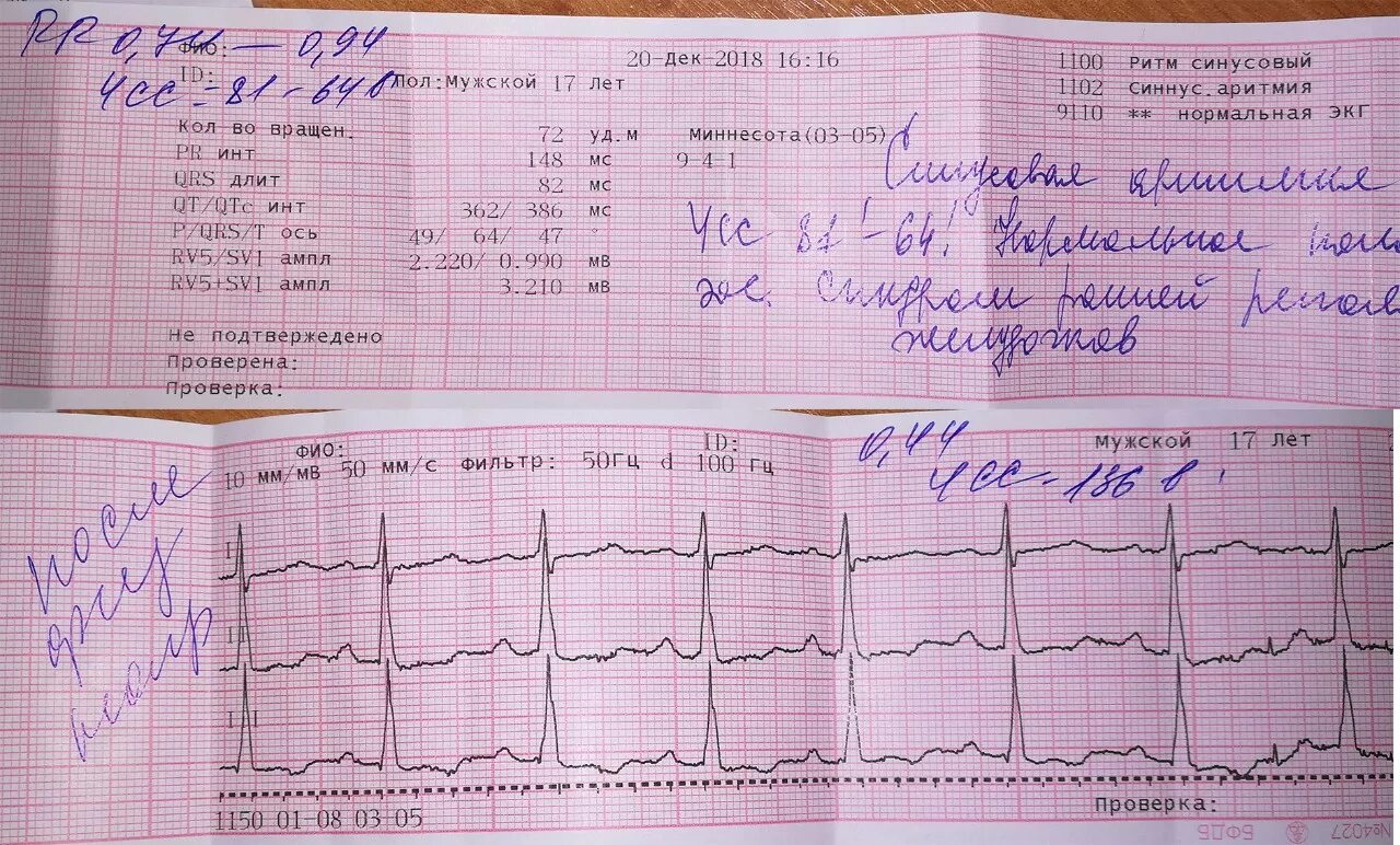 Расшифровка кардиограммы сердца у взрослых по фото Картинки РАСШИФРОВКА ЭКГ У ВЗРОСЛОГО ТАБЛИЦА