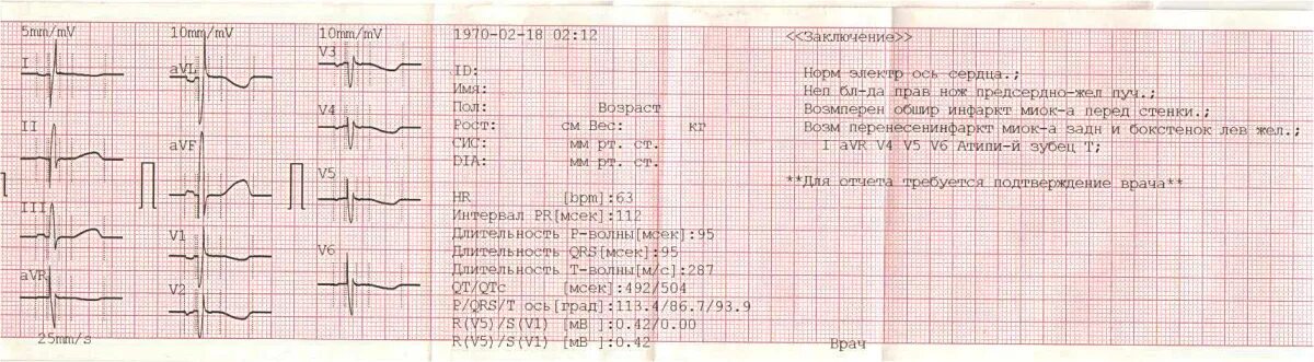 Расшифровка кардиограммы сердца у взрослых по фото Экг норма ударов - найдено 90 картинок