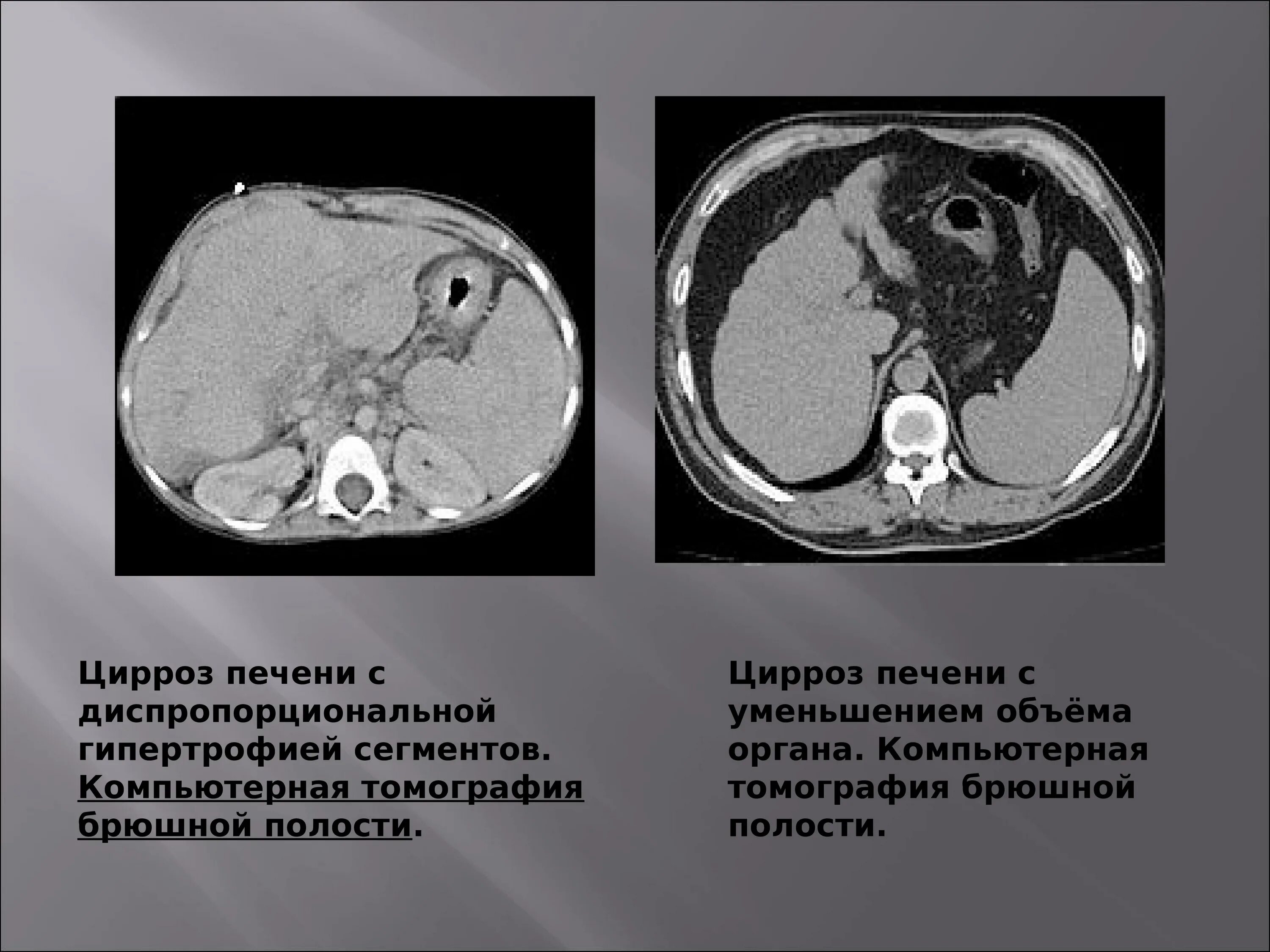 Расшифровка кт печени фото Кт печени описание: найдено 73 изображений