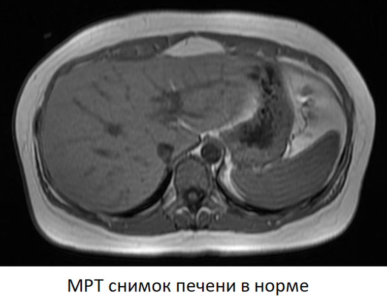 Расшифровка кт печени фото МРТ печени, что показывает - подготовка к МРТ печени