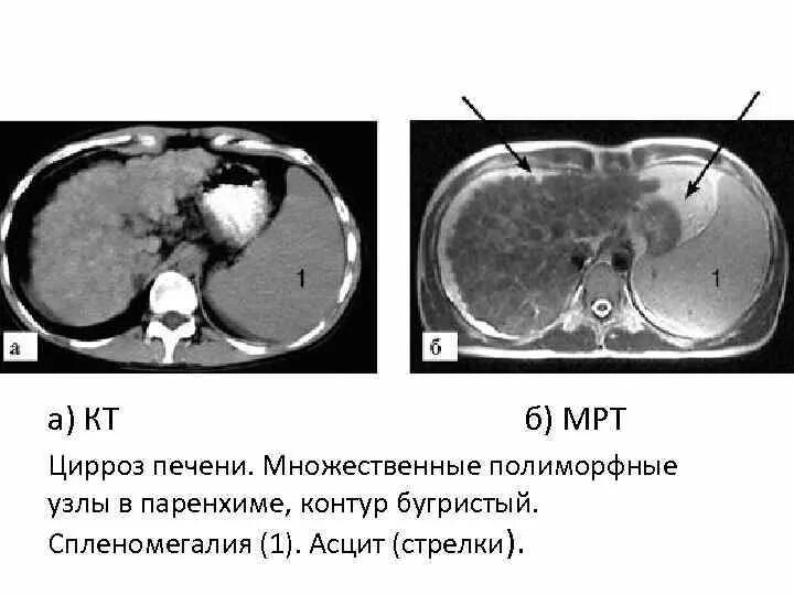 Расшифровка кт печени фото КТ печени с контрастированием - что это такое, подготовка к томографии, расшифро