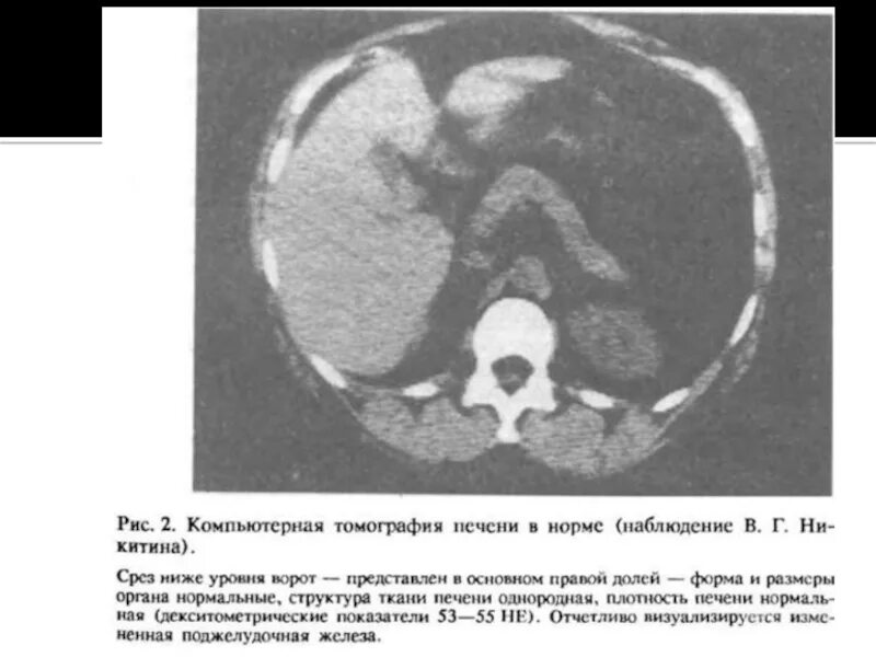 Расшифровка кт печени фото Кт печени и желчного пузыря: найдено 86 картинок