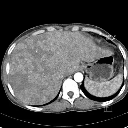 Расшифровка кт печени фото КТ печени - Виды КТ