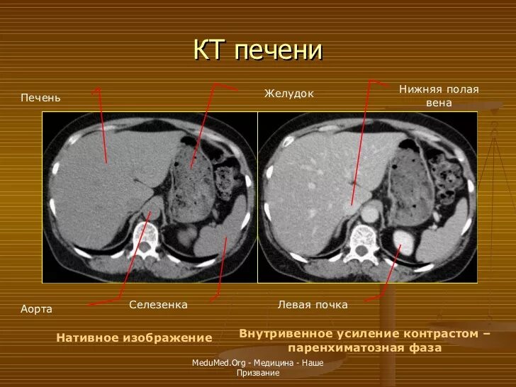 Расшифровка кт печени фото Mts кт