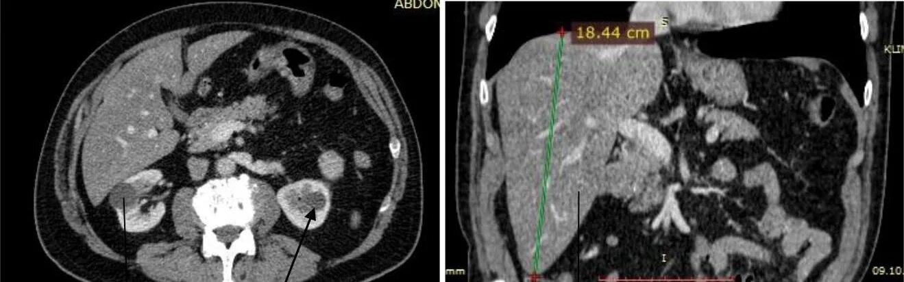 Расшифровка кт печени фото Гиперваскулярное образование почки Второе мнение