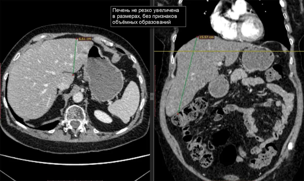 Расшифровка кт печени фото КТ признаки остеопороза Второе мнение