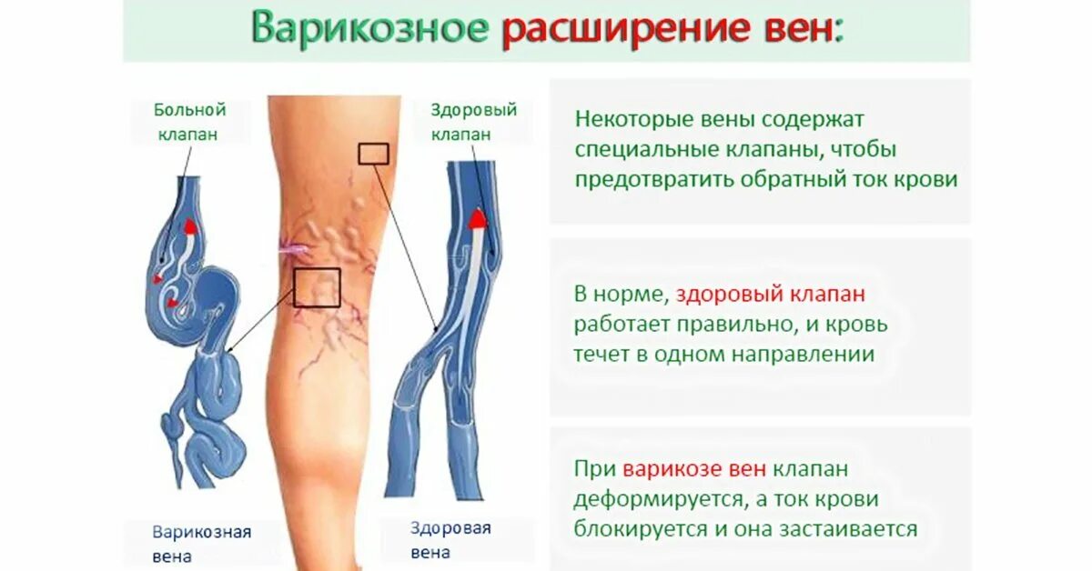 Расширение вен нижних конечностей фото Почему выступают вены на ногах: причины, профилактика и лечение