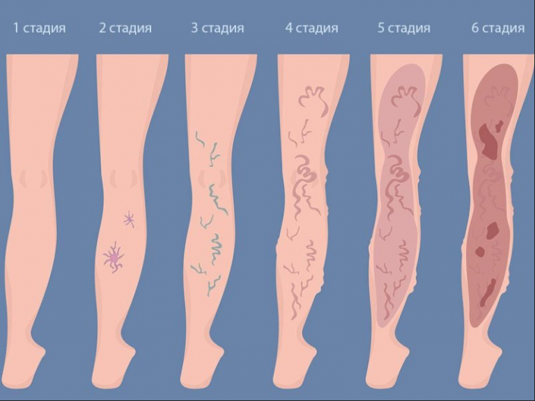 Расширение вен нижних конечностей фото Лечение трофических язв в Морозовске, запись, цены ООО Здоровье