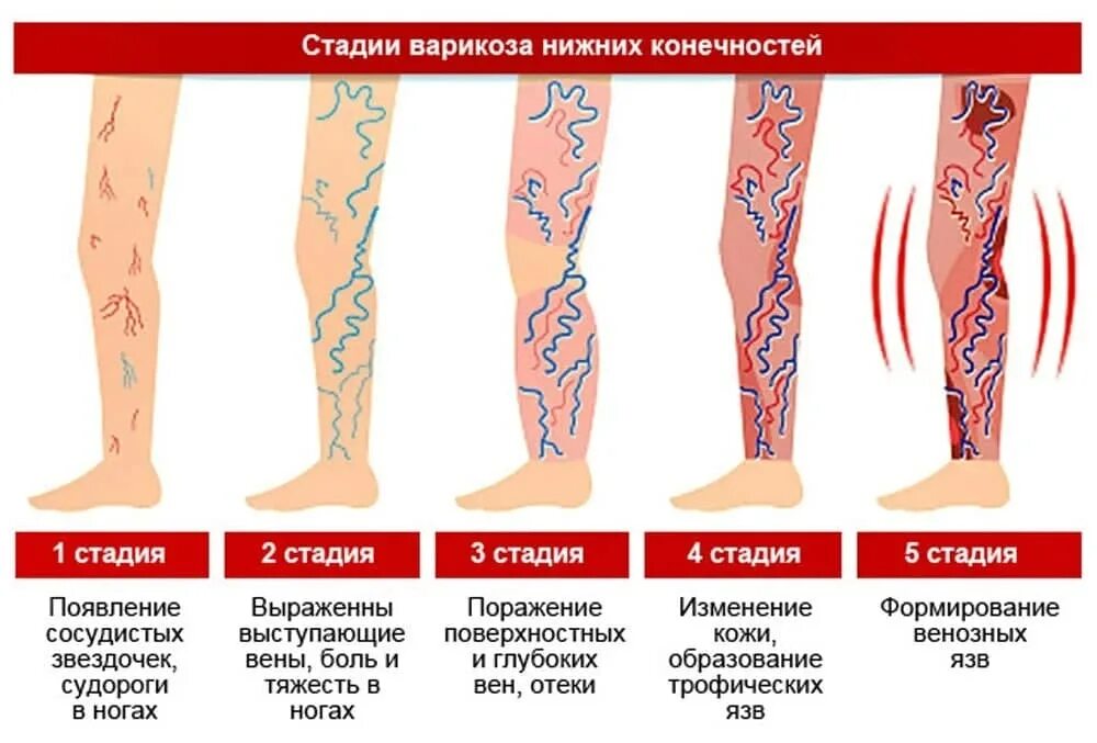 Расширение вен нижних конечностей фото Профилактика варикозного расширения вен нижних конечностей - Медицинский портал 