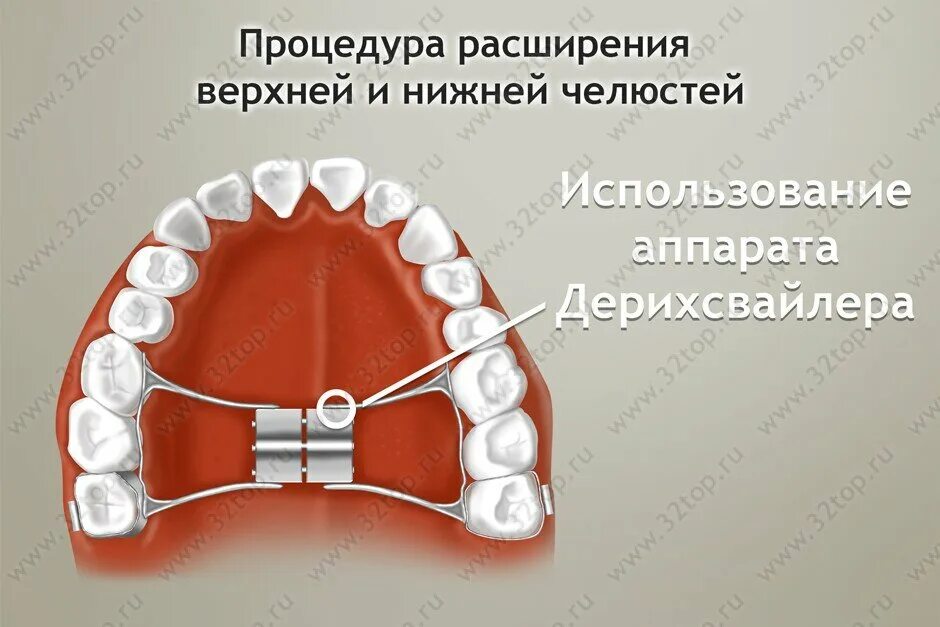 Расширяющий аппарат верхнюю челюсть фото Итоги года 2018 Пятница Дзен