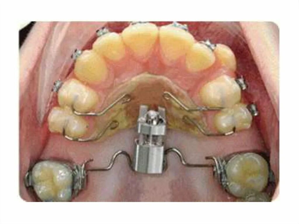 Расширяющий аппарат верхнюю челюсть фото Винты больно ли брекеты: найдено 90 изображений
