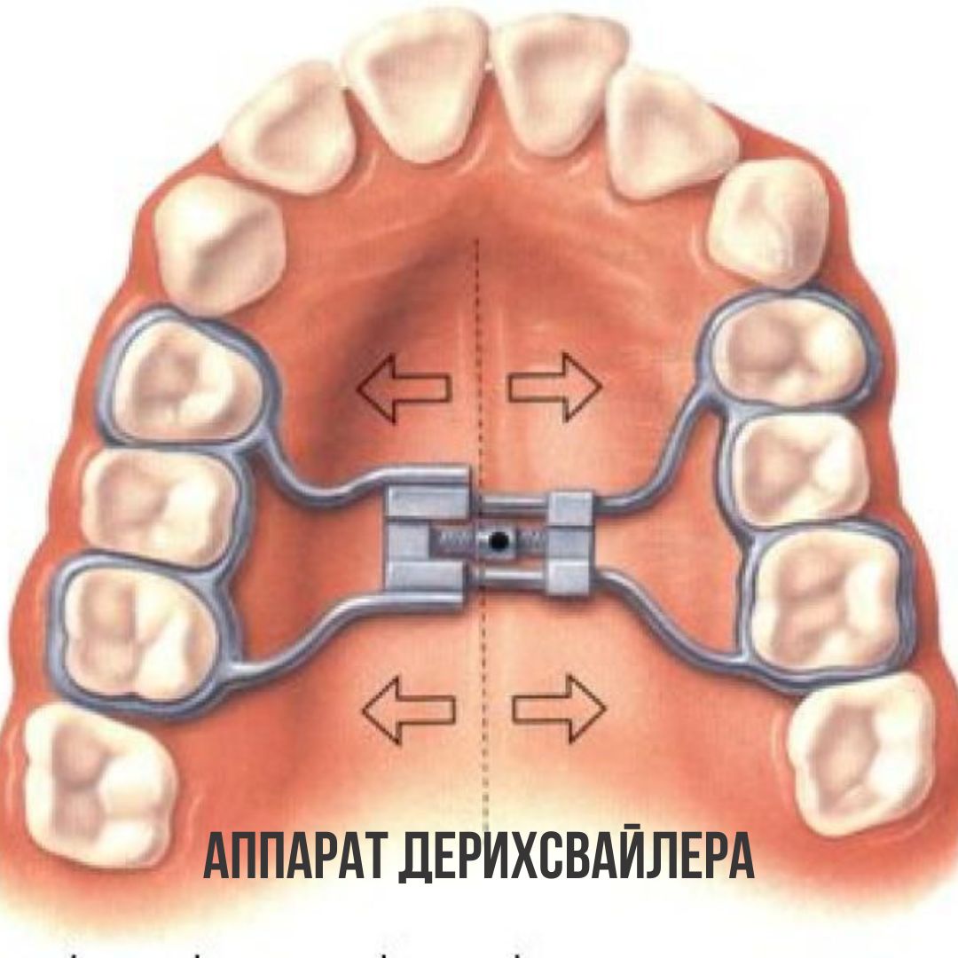 Расширяющий аппарат верхнюю челюсть фото Детская ортодонтия в Калуге, исправление прикуса у детей и подростков