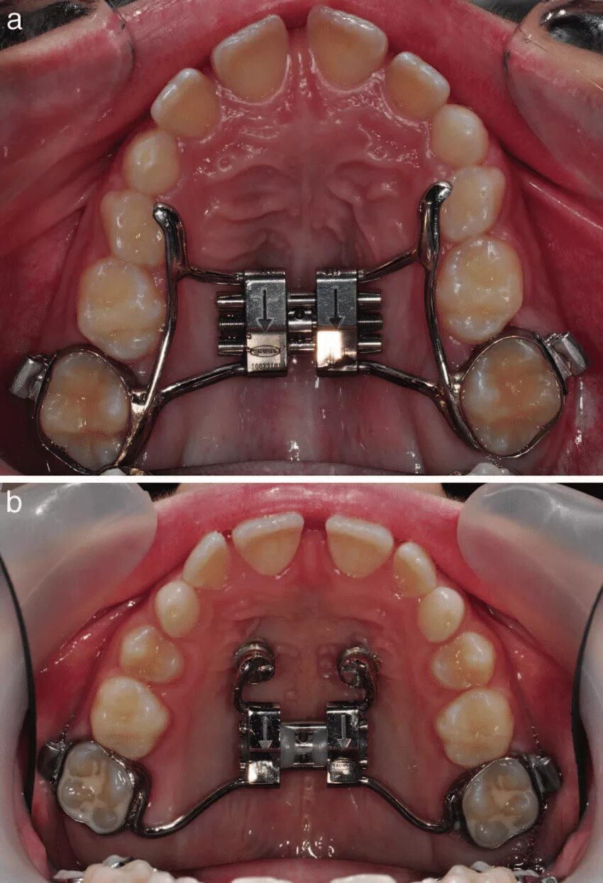 Расширяющий аппарат верхнюю челюсть фото a) Conventional hyrax expander; (b) hybrid hyrax expander anchored on... Downloa