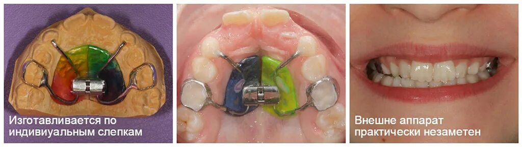 Расширяющий аппарат верхнюю челюсть фото Пластинка для зубов детям: съемная или несъемная. Какую выбрать?