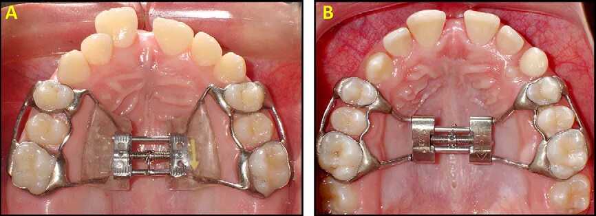 Расширяющий аппарат верхнюю челюсть фото Figure 1 from Immediate effects of rapid maxillary expansion with Haas-type and 