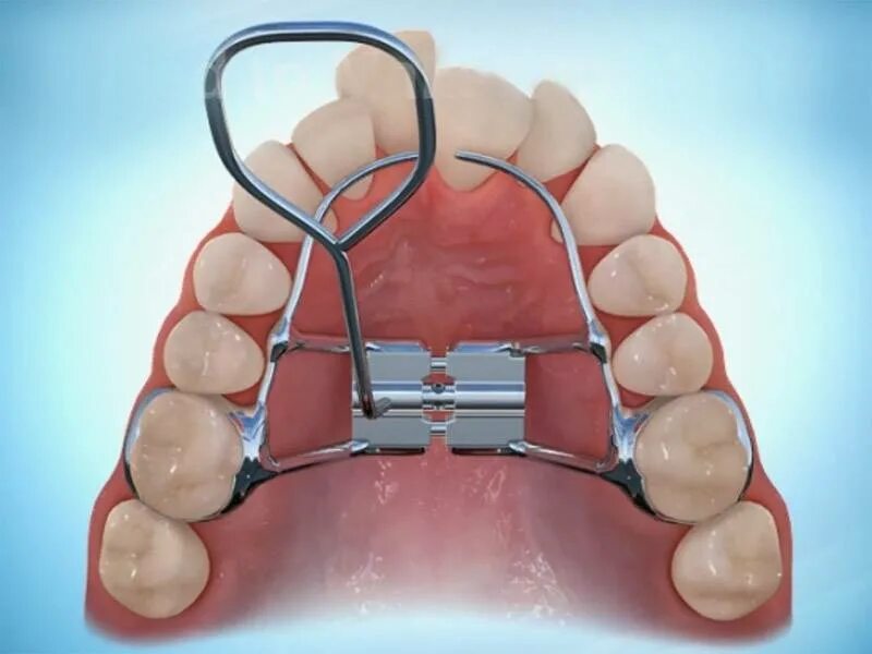 Расширяющий аппарат верхнюю челюсть фото Самые популярные способы протезирования зубов. Доступная стоматология и импланта