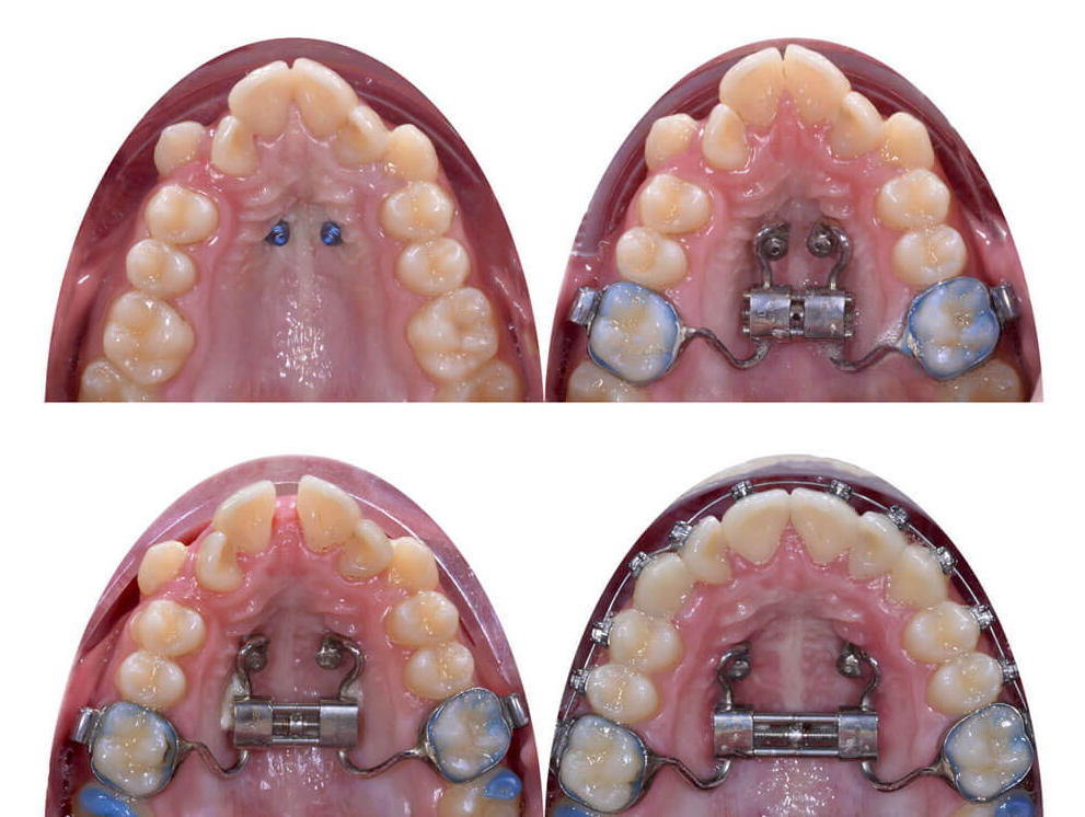 Расширяющий аппарат верхнюю челюсть фото Скелетное расширение в ортодонтии или аппараты MSE (MARPE)