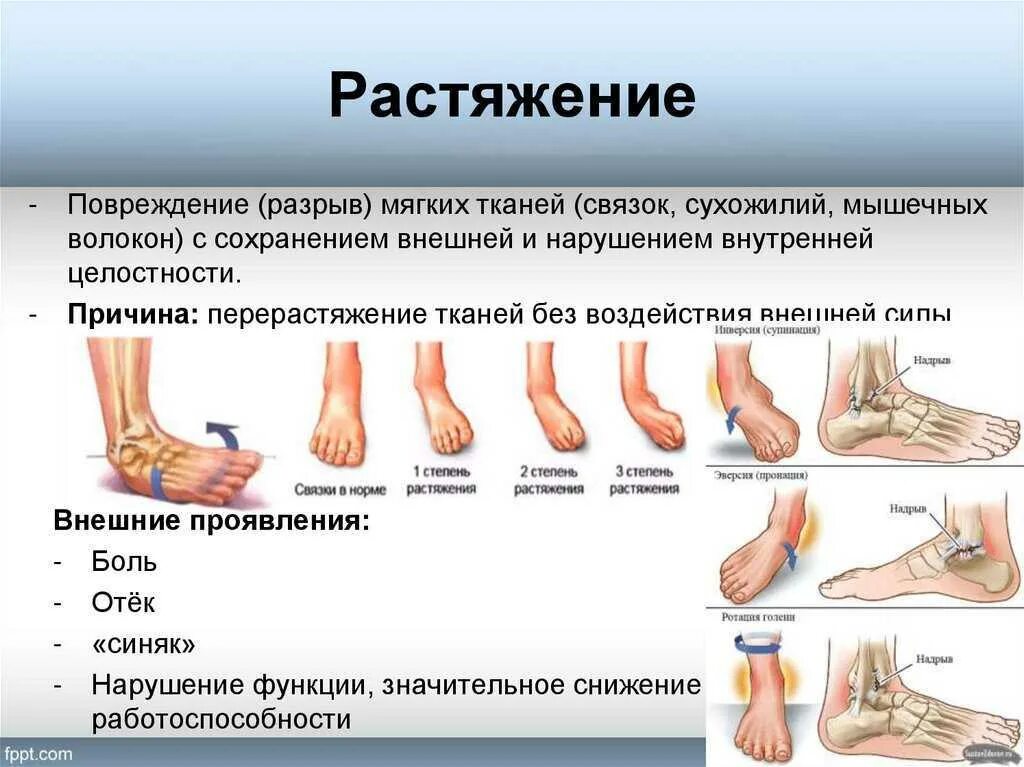 Растяжение голеностопа симптомы фото Картинки ТРАВМЫ СТОПЫ И ГОЛЕНОСТОПНОГО СУСТАВА