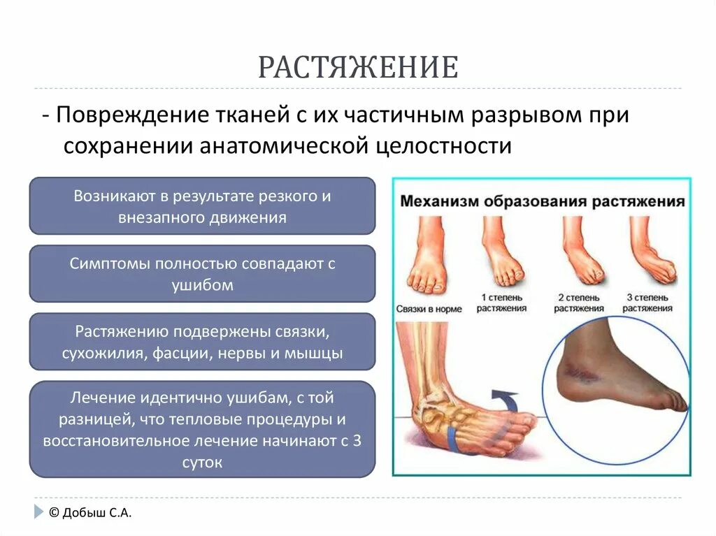 Растяжение голеностопа симптомы фото Картинки ПРИЗНАКИ РАСТЯЖЕНИЯ СВЯЗОК ГОЛЕНОСТОПНОГО