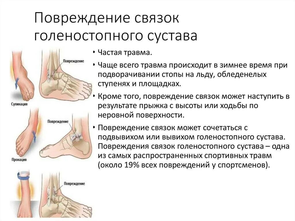 Растяжение голеностопа симптомы фото Растяжение связок голеностопного сустава, лечение в домашних условиях