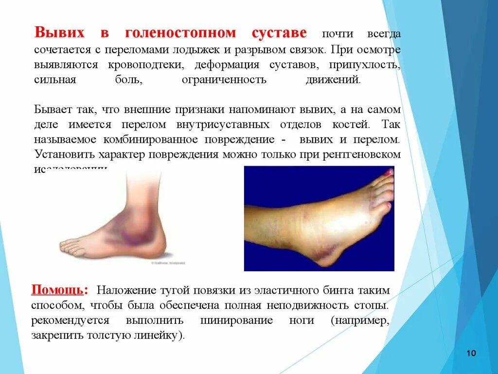 Растяжение голеностопа симптомы фото Картинки ПЕРВАЯ ПОМОЩЬ ПРИ РАСТЯЖЕНИИ ГОЛЕНОСТОПНОГО СУСТАВА