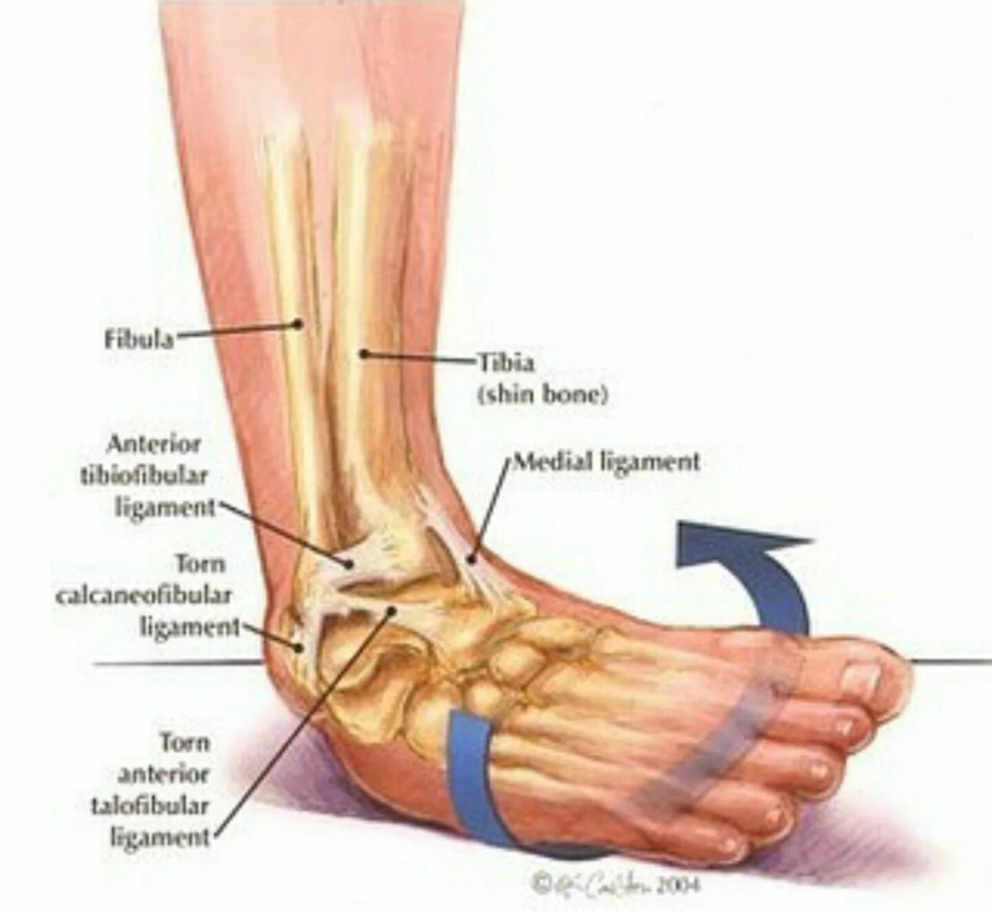 Растяжение голеностопа симптомы фото @doctor.macc Ankle sprain Ankle ligaments, Sprained ankle, Ankle anatomy