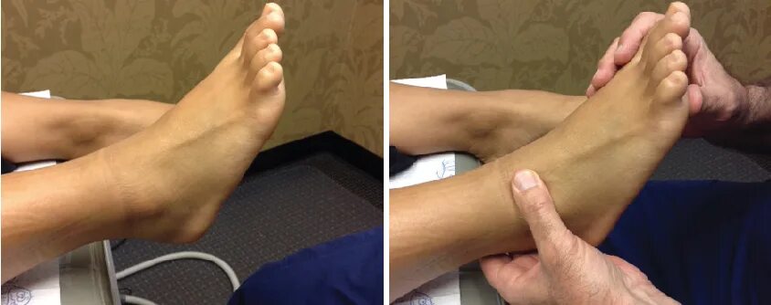 Растяжение голеностопного сустава симптомы фото Ankle sprain recovery protocol, ankle sprain protocol