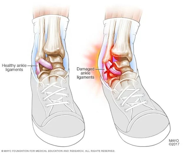 Растяжение голеностопного сустава симптомы фото Sprains - Symptoms and causes - Mayo Clinic