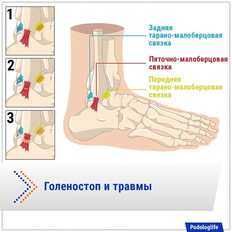 Растяжение голеностопного сустава симптомы фото Травмы связок голеностопного сустава можно подразделить на три степени тяжести: 