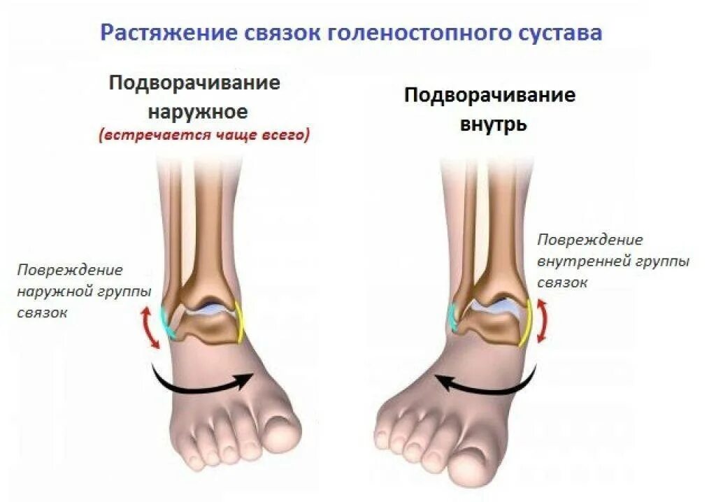 Растяжение симптомы фото Внутреннее растяжение связок