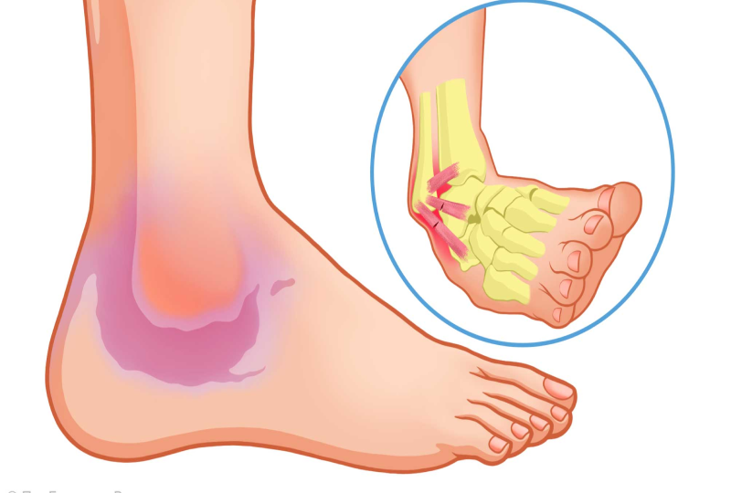 Растяжение симптомы фото Растяжение связок голеностопного сустава - как уменьшить боль и ускорить выздоро