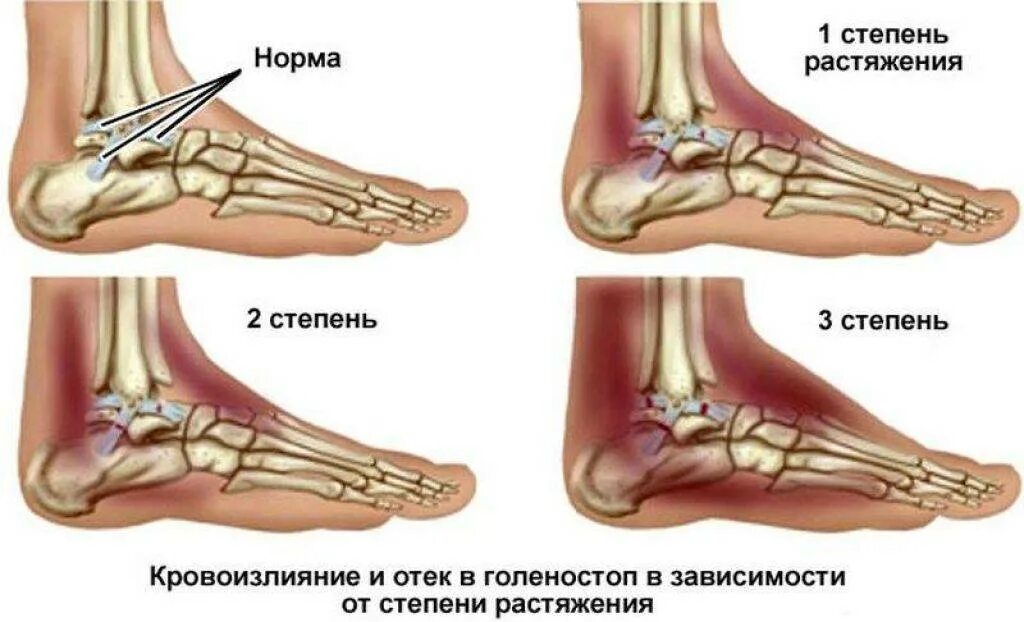 Растяжение стопы симптомы фото Внутреннее растяжение связок