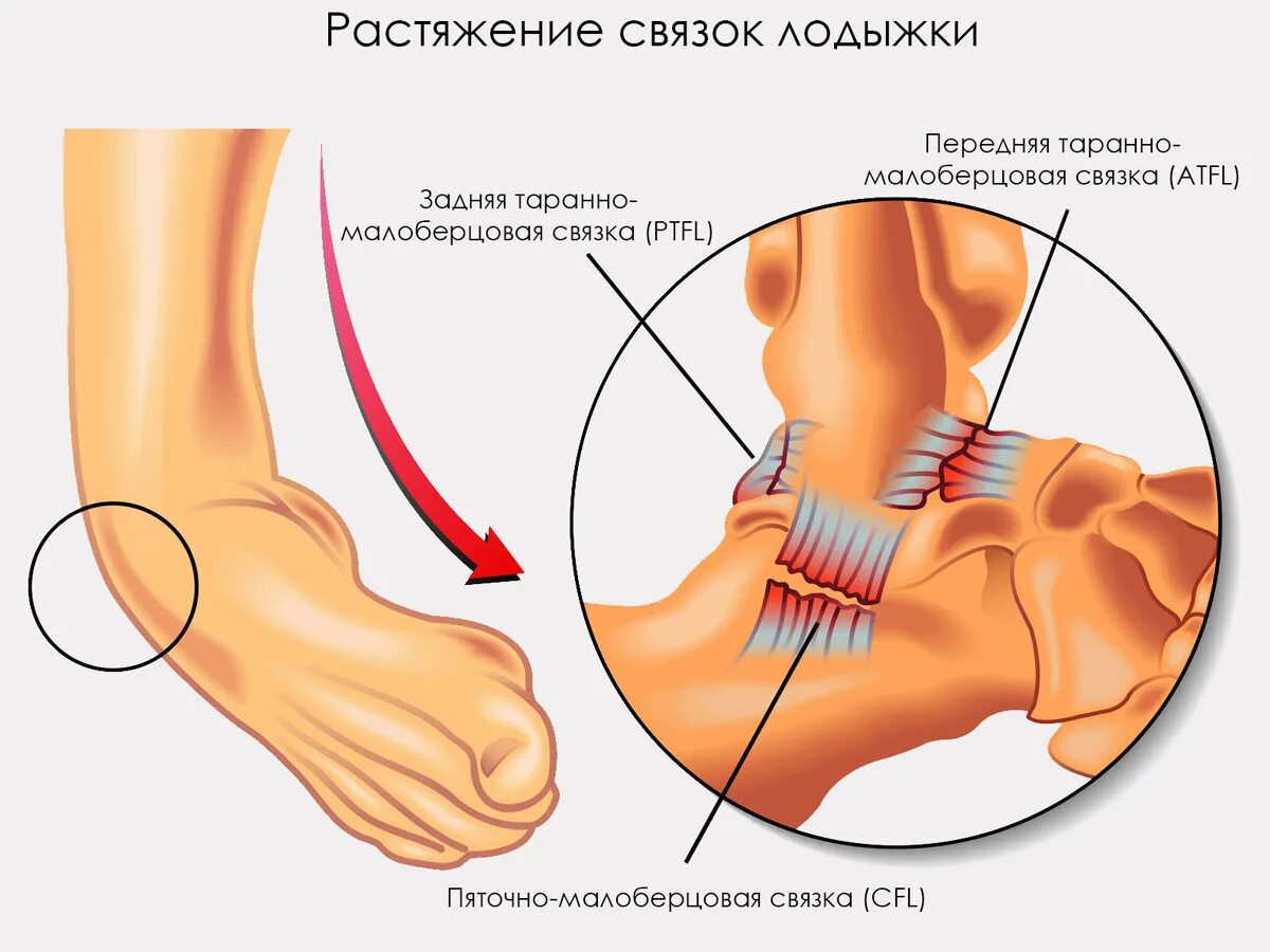 Растяжение связки голеностопа фото симптомы Анатомический ортез голеностопного сустава со стабилизирующими пластинами и пере