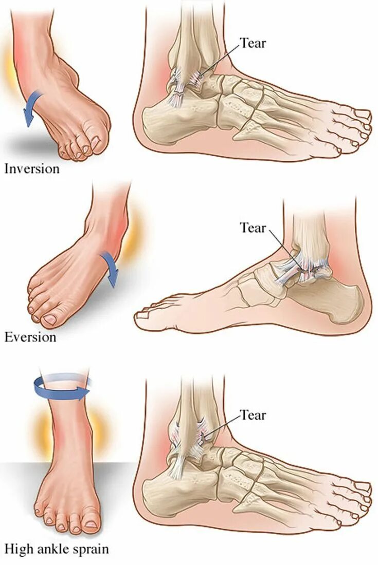 Растяжение связки голеностопа фото симптомы Ушиб связок голеностопного сустава